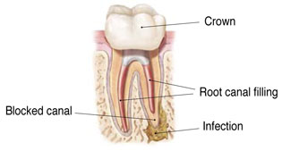 Endodontic procedure